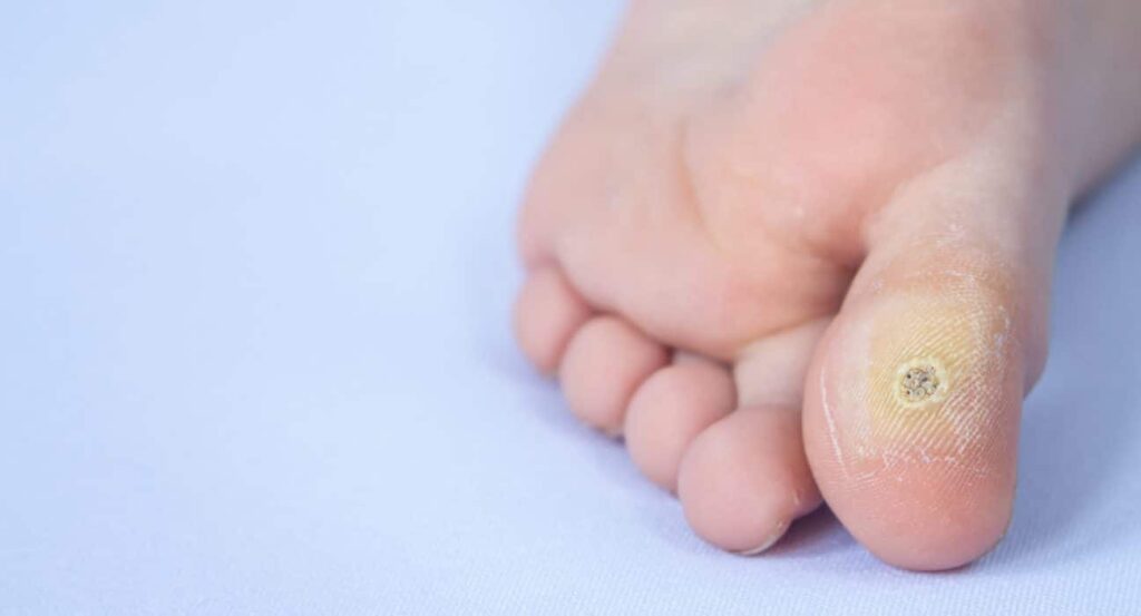 Combien de temps met le papillomavirus à se déclarer